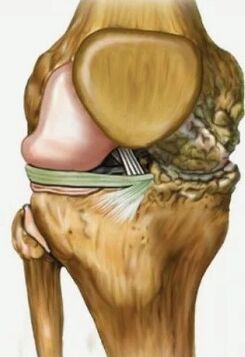 Artrosis de la articulación de la rodilla