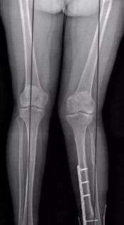 Deformaciones de la rodilla
