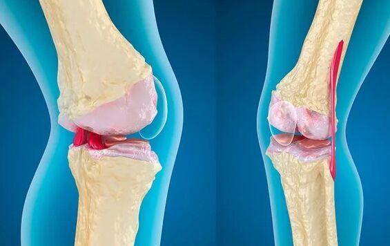 Gonartrosis del tercer grado de articulación de la rodilla