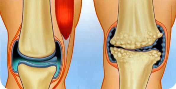 La condición normal de la articulación y las causas del desarrollo de la artrosis de la rodilla