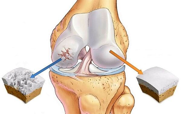 norma y desviación para la artrosis de la articulación de la rodilla