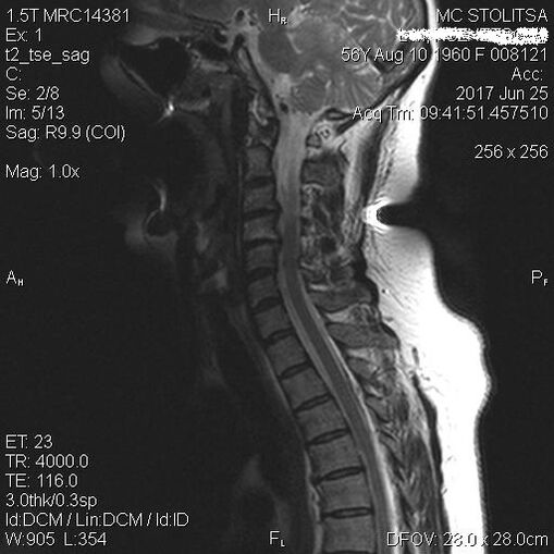 Osteocondrosis y espondilosis de la columna cervical