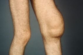 Las causas y síntomas de la artrosis de la articulación de la rodilla