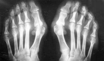 Diagnóstico diferencial de síntomas de artritis y artrosis
