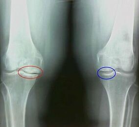 El resultado del tratamiento de la artritis y los remedios populares de la artrosis