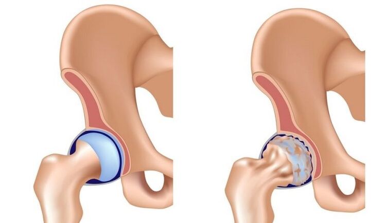 Sano y articular con artrosis